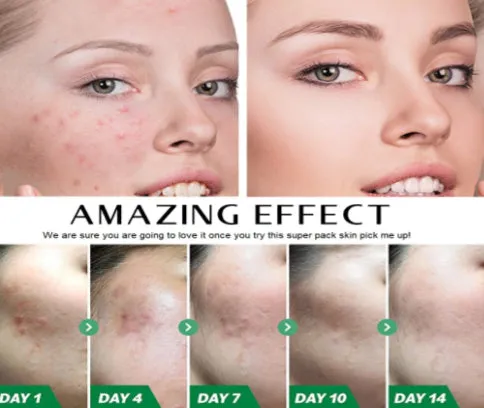 Freezing'Age Anti Acne Serum - MQO 200pcs